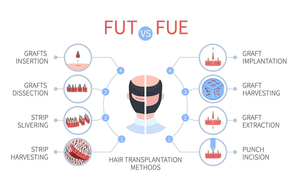 FUE vs FUT hair transplantation medical infographics