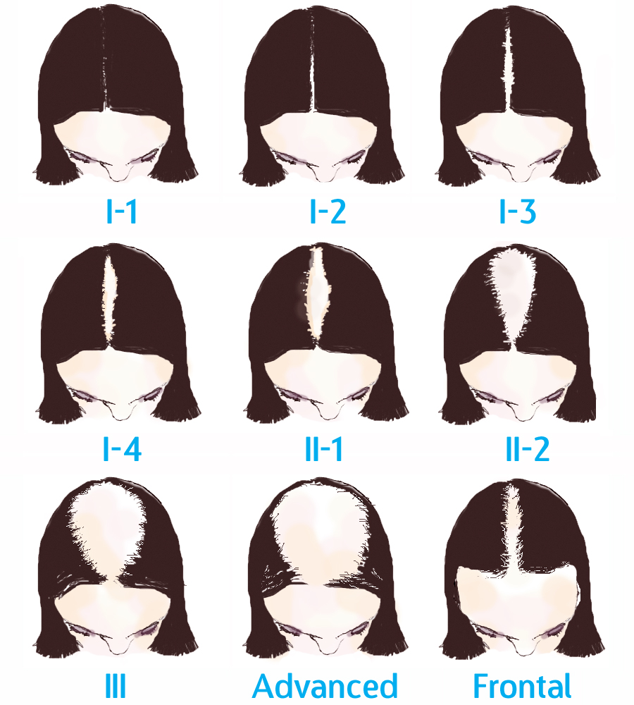 Female Hair Restoration - Houston Hair Restoration