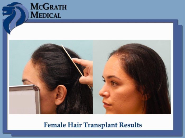 Before & After Female Patients - Houston Hair Restoration