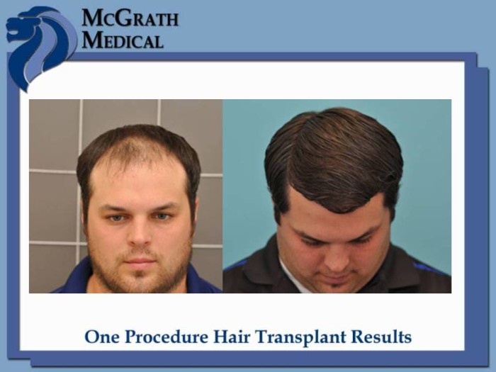 Before & After Hair Transplant Photos Houston Hair Restoration