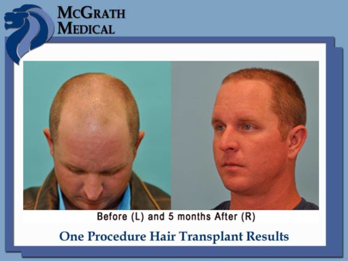 Before & After Hair Transplant Photos Houston Hair Restoration