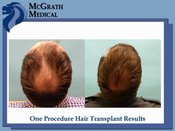 Before & After Hair Transplant Photos Houston Hair Restoration