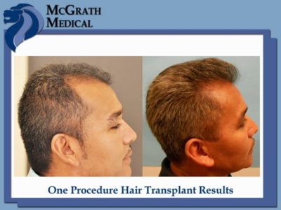 Before & After Hair Transplant Photos - Houston Hair Restoration