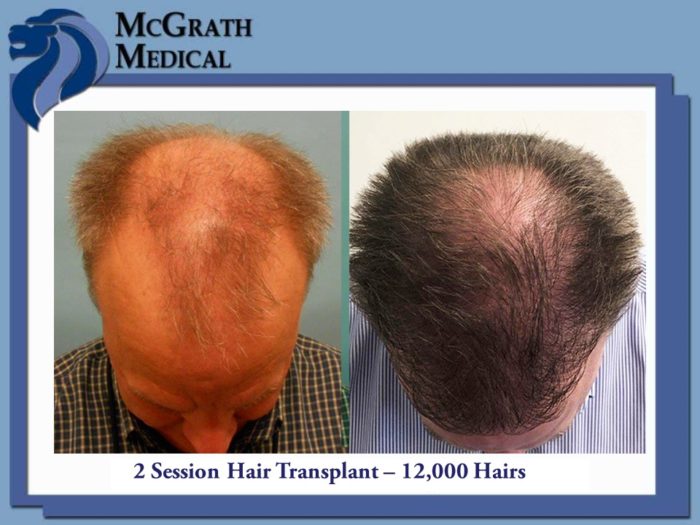 Hair Transplant Houston - Dr. Dan McGrath - Medical Hair Restoration in  Houston Texas | Follicular Unit Hair Transplantation , FUE. Follicular Unit  Extraction