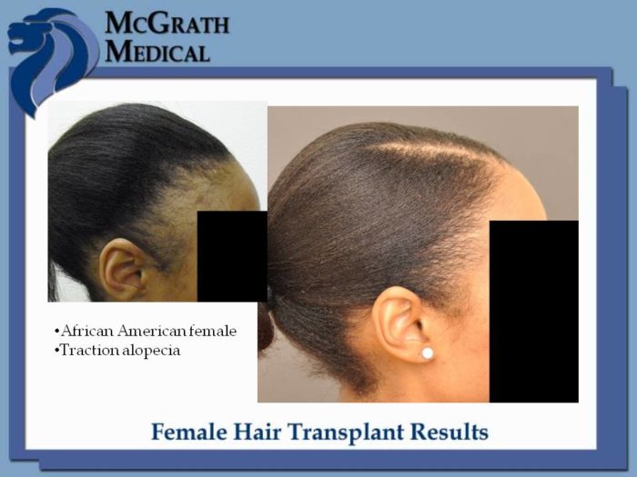 Before & After Female Patients - Houston Hair Restoration